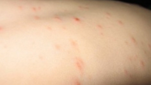 През изминалата седмица регистрираната в РЗИ Варна остра заразна