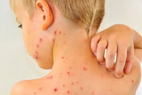 Бум на варицела във Врачанско e отчетена през изминалата седмица