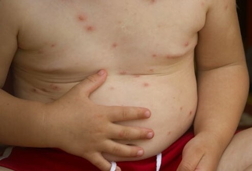 Спада броят на новите случаи на заразени с варицела във