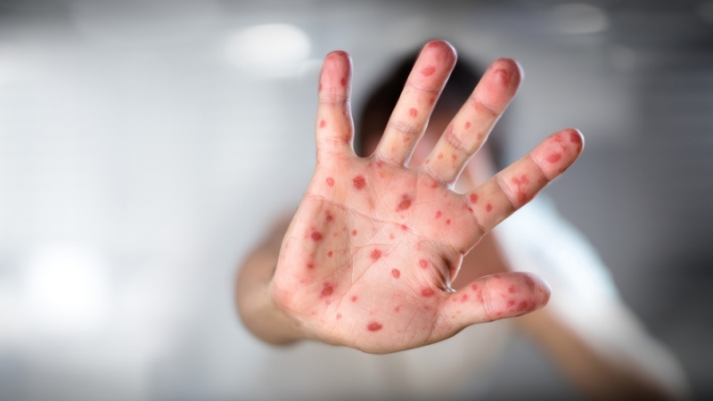 Бум на морбили е предизвикал смъртта на десетки бебета и