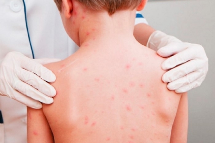 Ръст на заболелите от варицела се отчита във Врачанско Справка