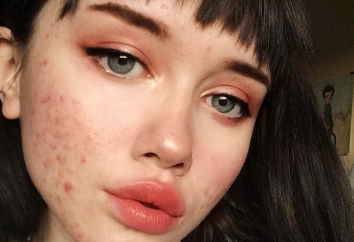 Правилното хранене е важен компонент в борбата срещу акнето Експерти