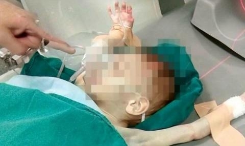 Подобрява се състоянието на тригодишните близначета от Пловдив неглижирани от