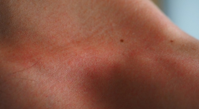 Обикновената бенка е образувание на кожата което се появява при