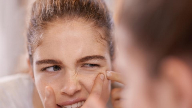 Млечните продукти и бързите въглехидрати са противопоказни за акнето това