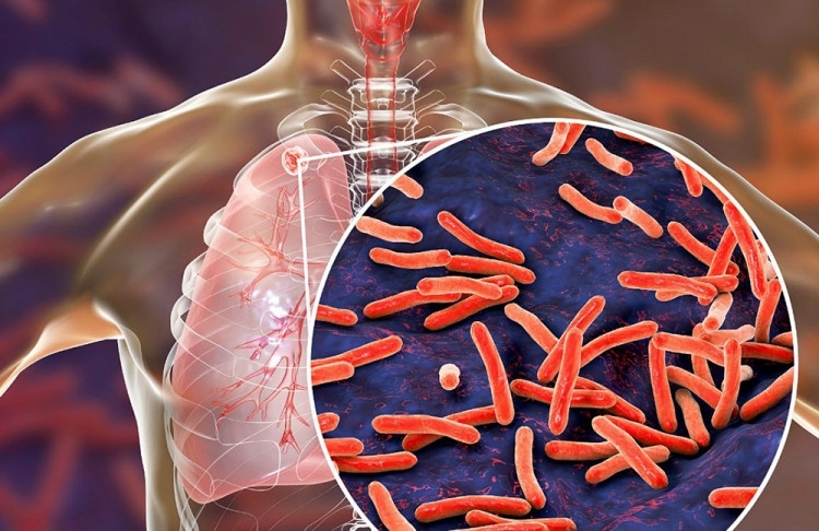 Туберкулозата е една от най смъртоносните болести в света Това е основната