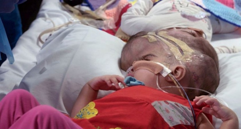 Британски лекари обявиха че са разделили успешно с няколко операции