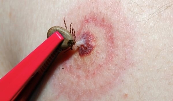 Първи случай на лаймска болест е регистриран във Враца за