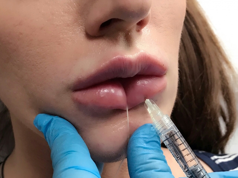 Абитуриентките минаха на филъри за устни Зрелостничките вече отказват да