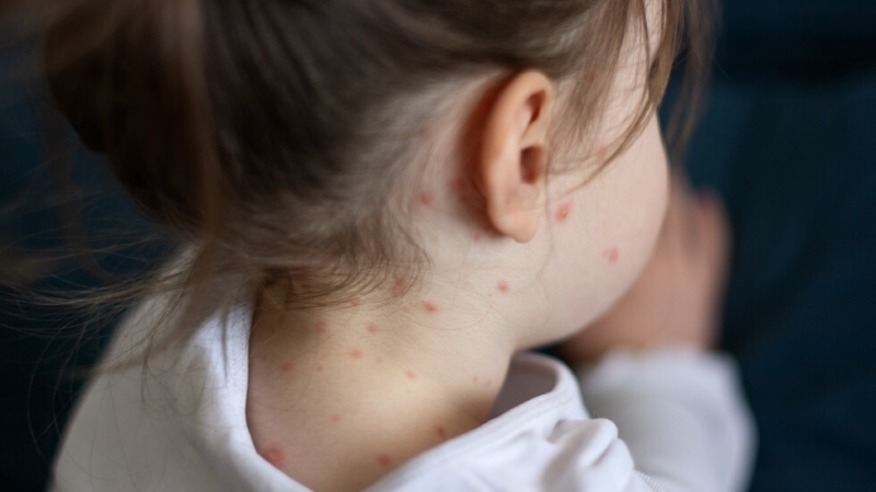Министерството на здравеопазването на Румъния обяви епидемия от дребна шарка