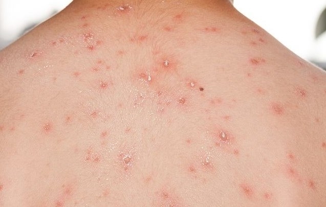 Първи случай на маймунска шарка в Румъния Румънското здравно министерство съобщи