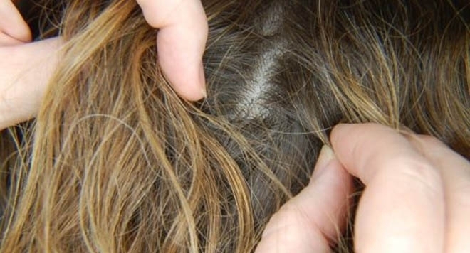 Училищата и детските градини в Монтанско пламнаха от въшки а