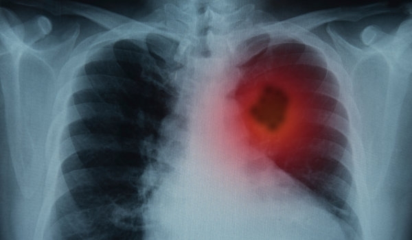Всяка година в страната ни се диагностицират 4250 нови случая