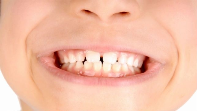 Всяко дете до 7 години има поне четири кариеса а