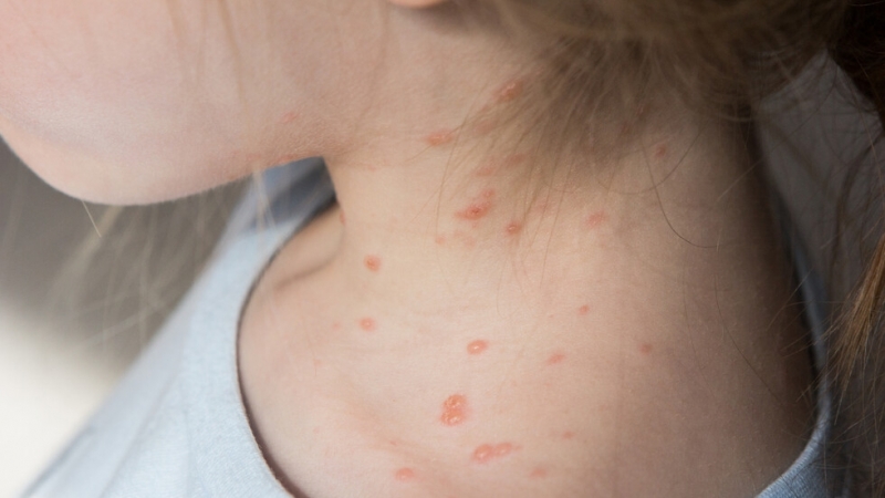 Нови случаи на варицела и скарлатина във Враца За това