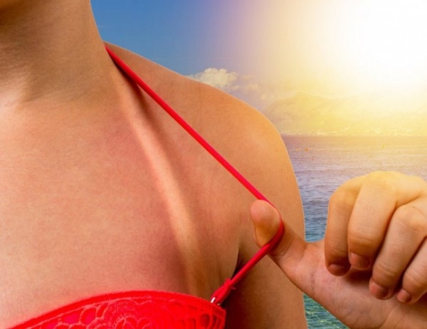 Слънчевото изгаряне е често срещан проблем през лятото Въпреки че