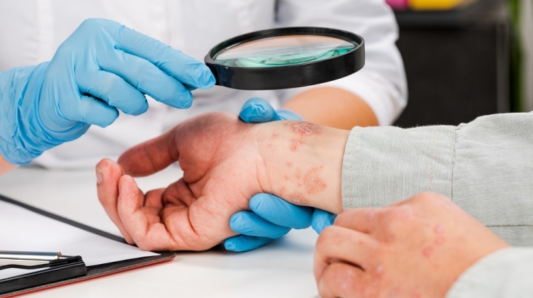 За още един случай на сифилис съобщават здравните власти във