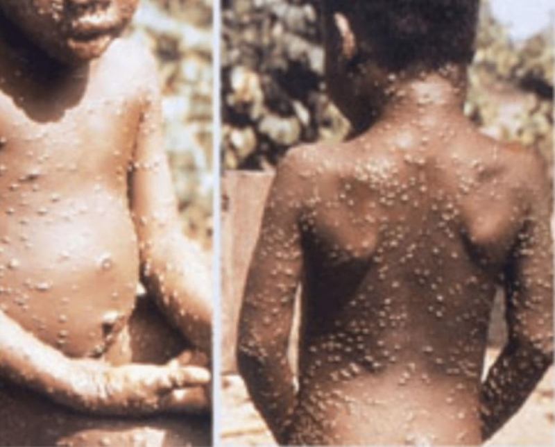 Здравните власти у нас разпространиха важна информация свързана с маймунската