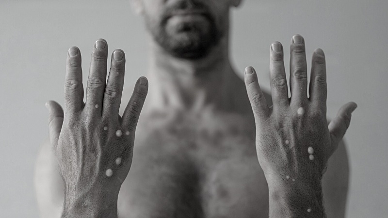 Световната здравна организация СЗО призова за спешни действия срещу маймунската шарка в