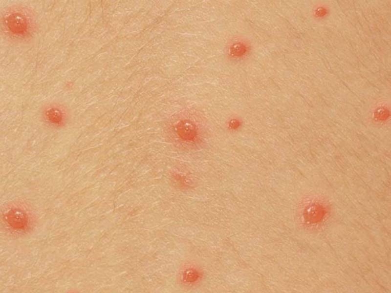 Продължава да расте броят на заразените с варицела в Монтанско